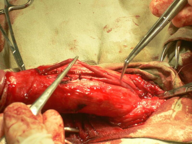 Lipofilling do pene para a ampliación