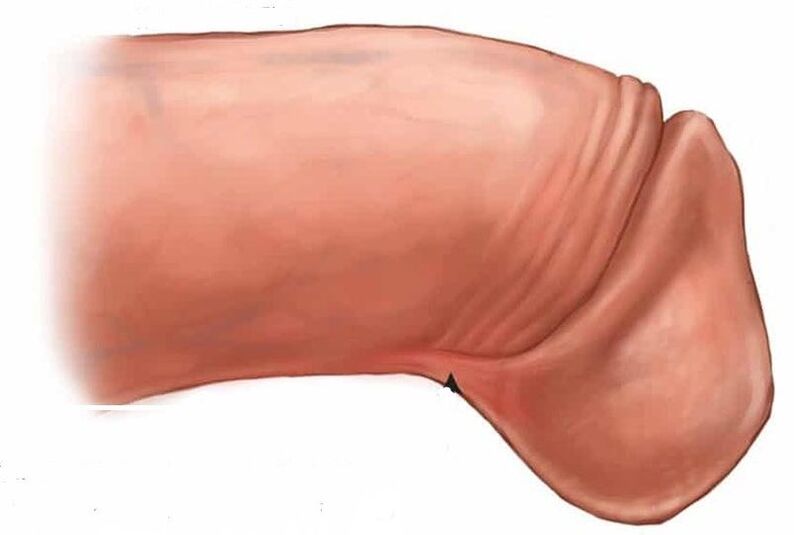 como agrandar o glande